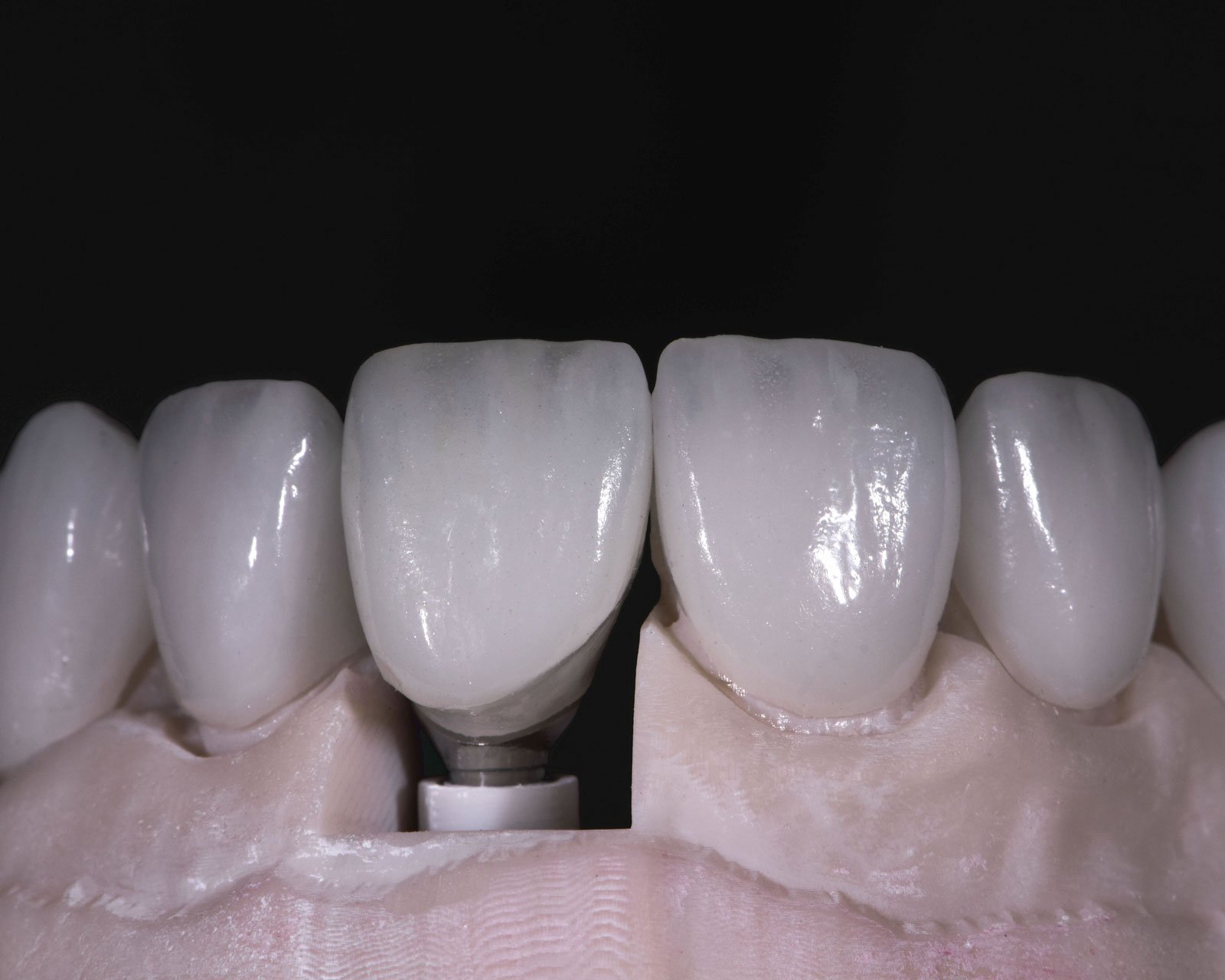 Denture